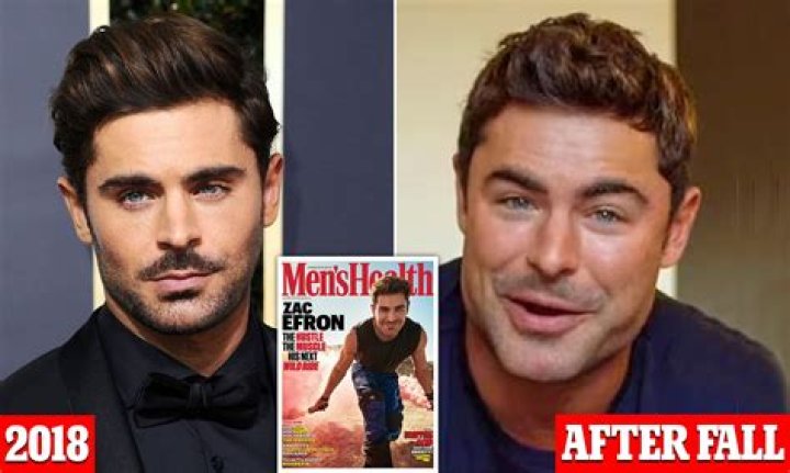 
Has Zac Efron Done Botox And Jaw Surgery – Before And After Photos 