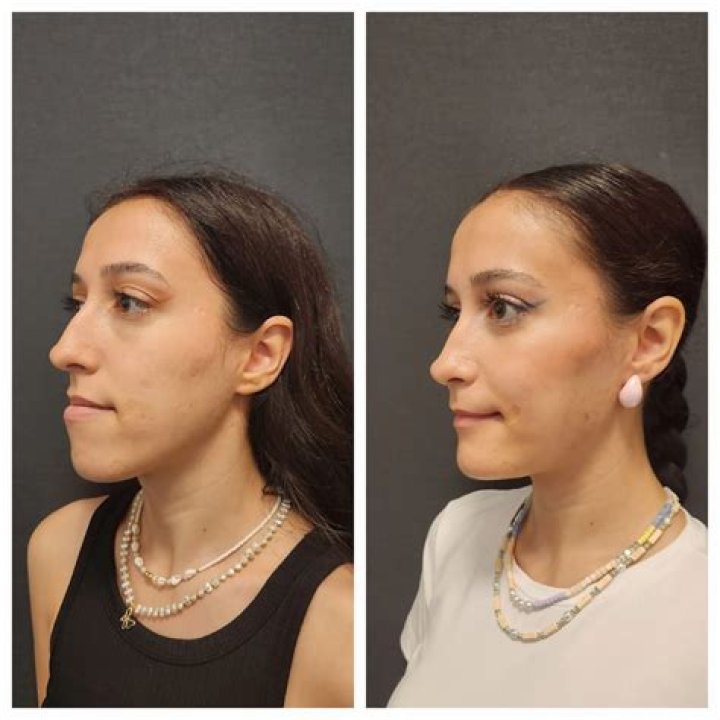 
Home And Away Star Emily Symons Weight Loss Before Jaw Surgery And Procedure 